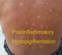 Post-inflammatory hypopigmentation (PIH) is a skin condition where lighter patches develop following inflammation or injury to the skin.