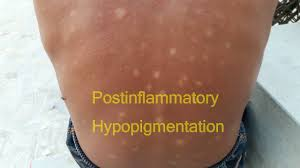 Post-inflammatory hypopigmentation (PIH) is a skin condition where lighter patches develop following inflammation or injury to the skin.