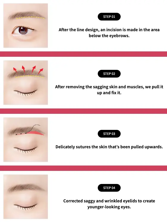 Brow Lift Surgery: Various surgical methods including endoscopic brow lifts, direct temporal browplasty