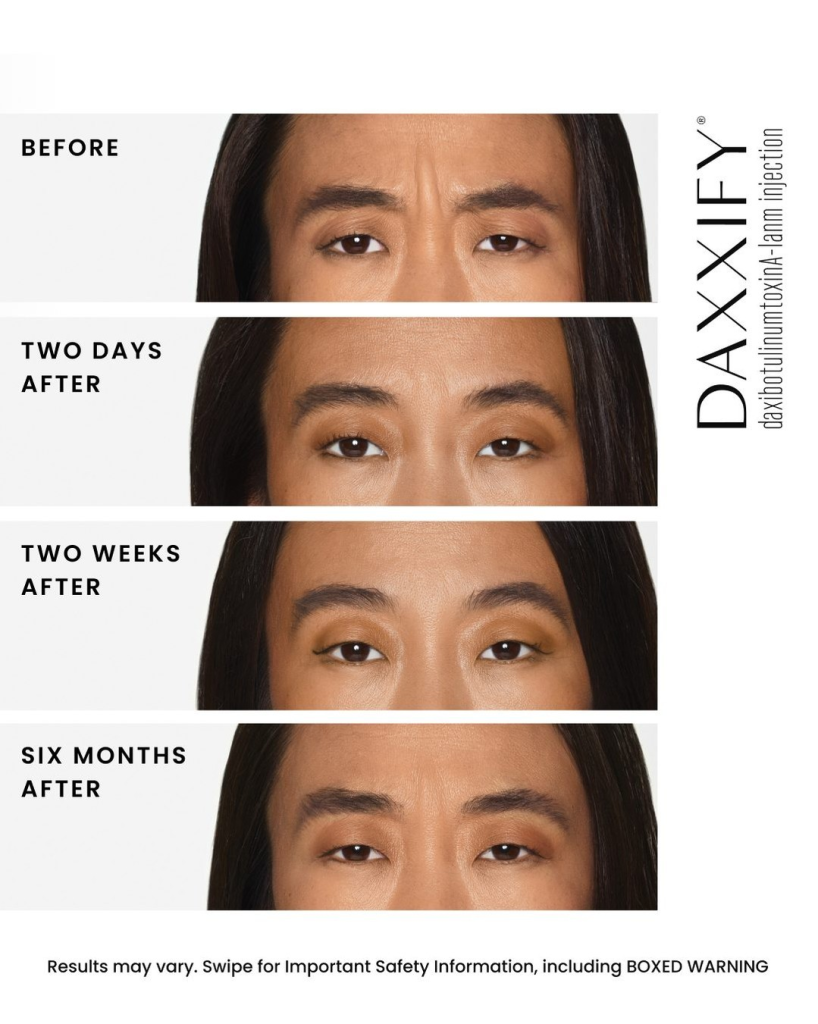 Daxxify and Other Collagen-stimulating Treatments: Promote natural brow firming over time.