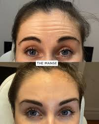 Forehead wrinkles are horizontal lines that appear across the forehead, often caused by repetitive facial expressions like raising your eyebrows, frowning, or squinting.