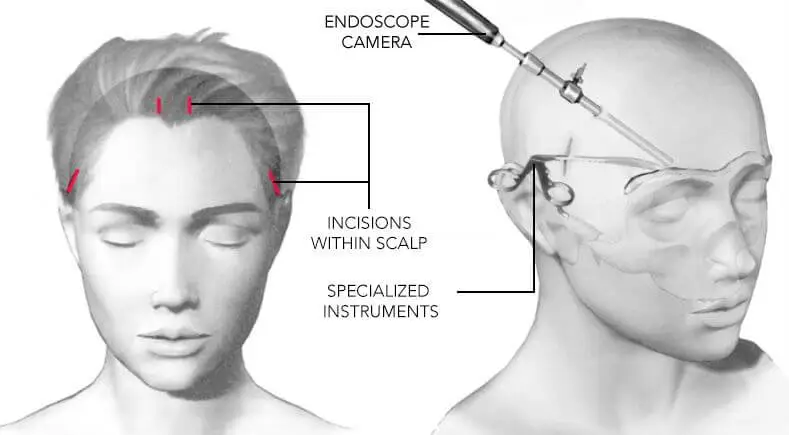 Forehead Lift (Brow Lift): Surgical elevation of the brow and smoothing of forehead skin, providing long-lasting results.