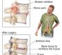 Spinal fusion surgery is a procedure designed to permanently connect two or more vertebrae in the spine, essentially "welding" them together to eliminate movement between these bones. This surgery helps stabilize the spine, reduce pain, and correct deformities or instability in the spinal column123.