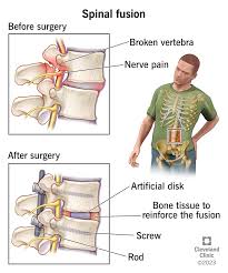 Spinal fusion surgery is a procedure designed to permanently connect two or more vertebrae in the spine, essentially "welding" them together to eliminate movement between these bones. This surgery helps stabilize the spine, reduce pain, and correct deformities or instability in the spinal column123.