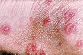 Erythema (ERM) is redness of the skin or mucous membranes, caused by increased blood flow (hyperemia) in superficial capillaries.