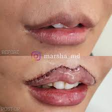 Direct (Gullwing) Lip Lift: