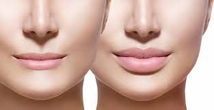 Lips and Cosmetic Surgery aims to enhance lip volume, shape, and definition to achieve a youthful and balanced facial aesthetic.