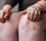 Pruritus (Prt) is the medical term for itching—an unpleasant skin sensation provoking the desire to scratch. It is a common symptom encountered in dermatology and general medical practice