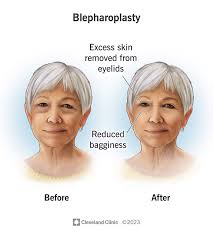Blepharoplasty, commonly known as eyelid surgery, is a cosmetic and functional procedure aimed at improving the appearance of the upper and/or lower eyelids.