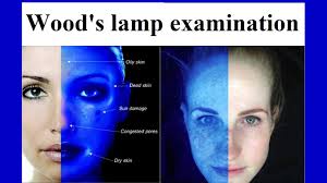 A Wood’s lamp is a diagnostic tool used in dermatology and other clinical fields, employing ultraviolet (UV) light to reveal changes in skin pigmentation, detect infections, and evaluate metabolic or cosmetic conditions.