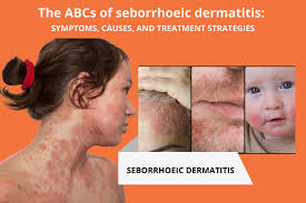 Seborrheic dermatitis is a common, chronic, or relapsing inflammatory skin condition that affects oily (sebaceous) areas of the body such as the scalp, face (around the nose, eyebrows, ears), and trunk.