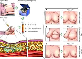 Fat grafting, also called fat transfer or autologous fat transplantation, is a surgical procedure in which fat is removed from one area of the body and injected into another to restore volume, improve contour, or repair defects.