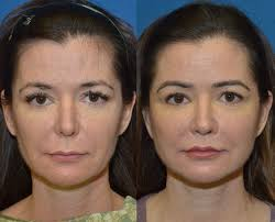 A lip lift is a surgical procedure designed to elevate the upper lip by shortening the distance between the nose and the lip (philtrum).