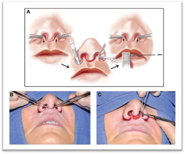 Lip Lift Procedure Steps