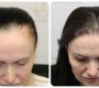 Hair transplantation is a surgical technique that moves hair follicles from a donor site, typically an area of dense hair growth on the scalp, to a bald or thinning recipient site