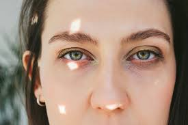 Hooded eyelids occur when excess skin folds downward from the brow bone, covering the crease of the upper eyelid.